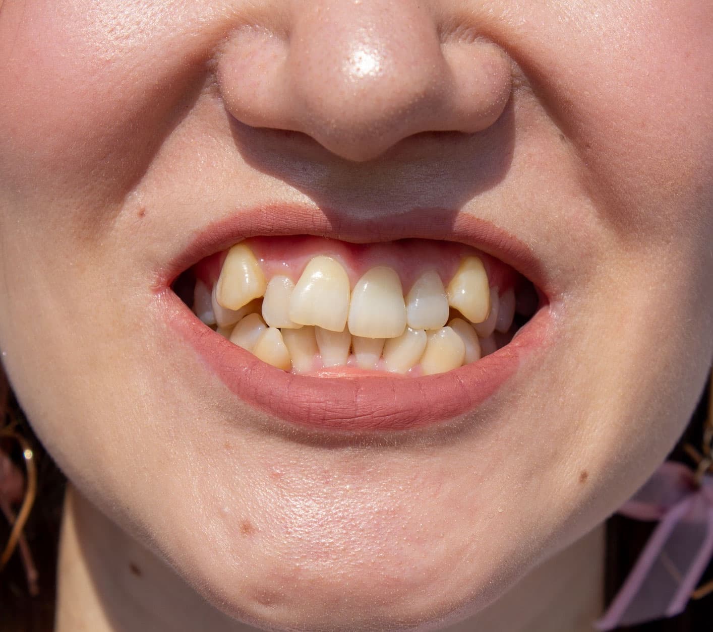 does-every-crooked-tooth-need-fixed-clips