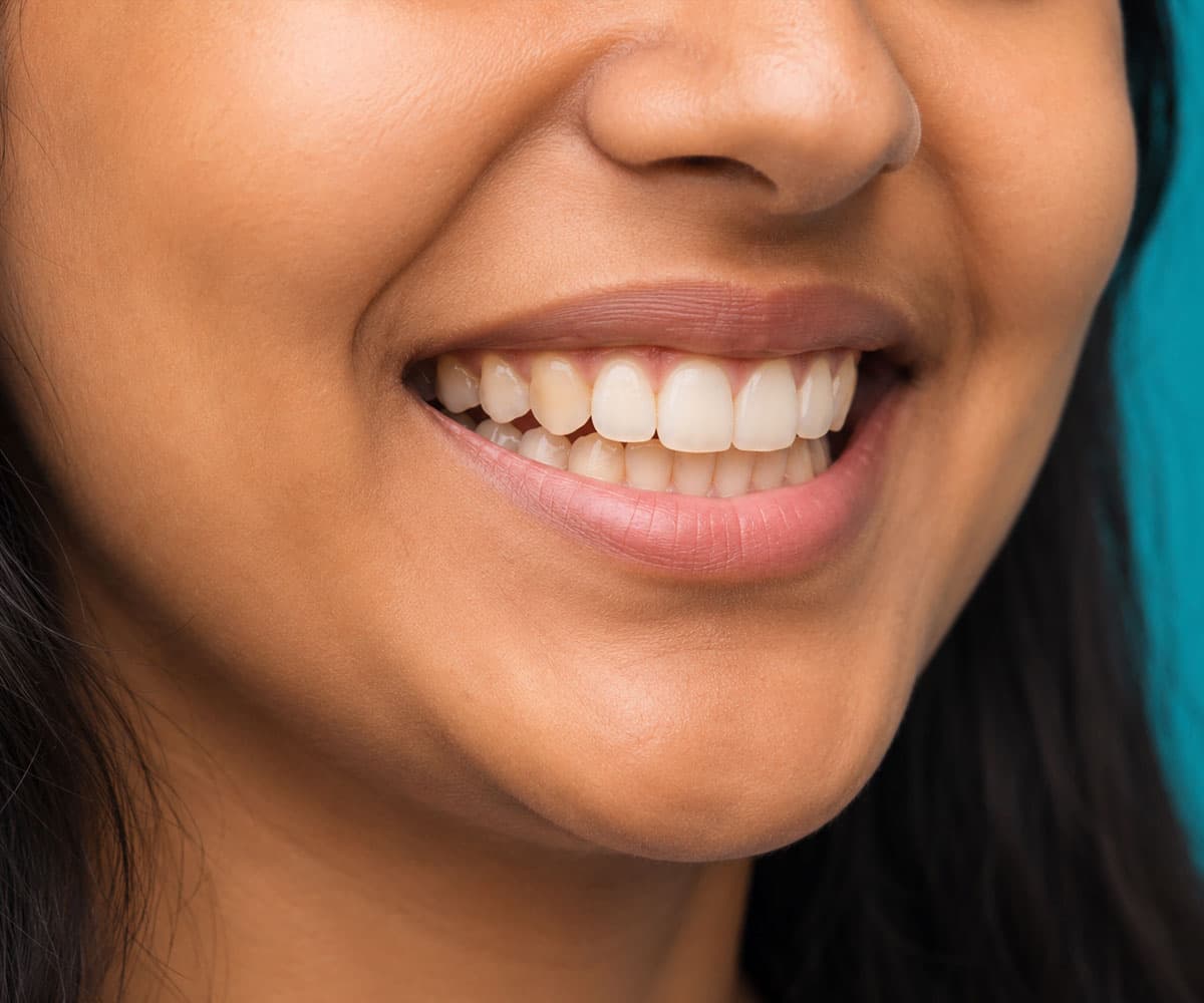 how-dental-fluorosis-treatment-improves-teeth