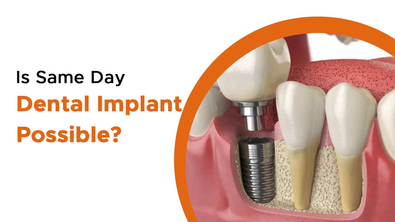 Is Same Day Dental Implant Possible