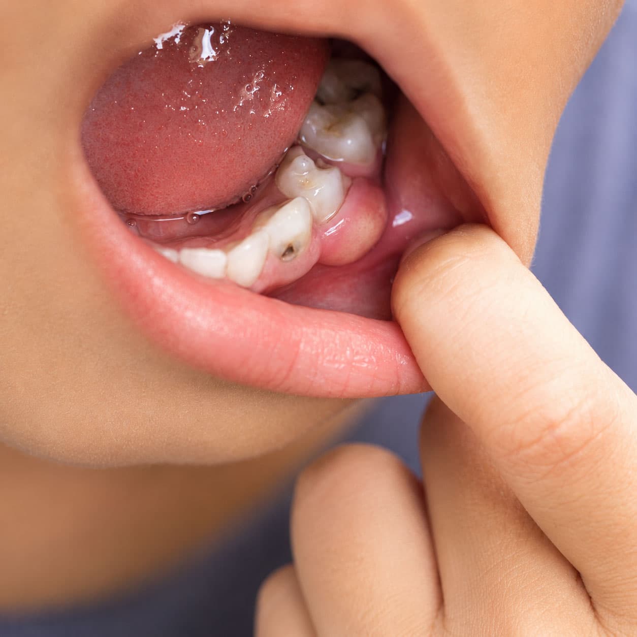 signs-you-may-need-dental-abscess-treatment