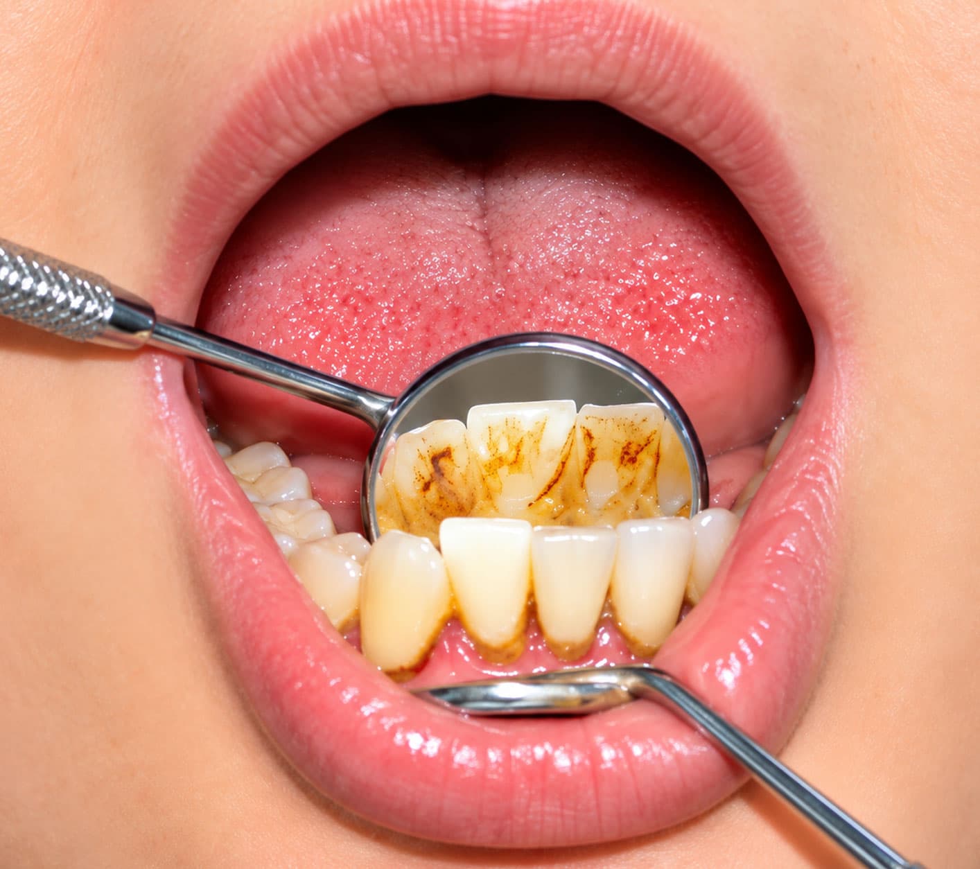 signs-you-may-need-dental-calculus-treatment