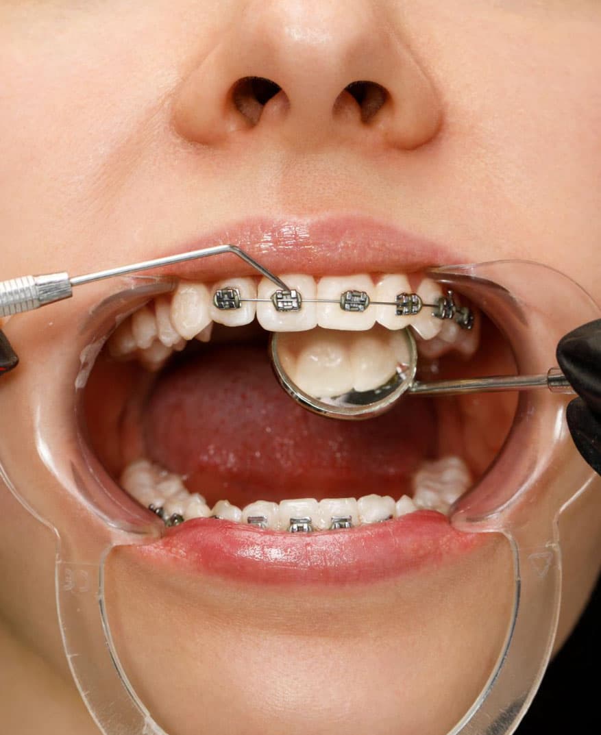 what-are-dental-clips-and-when-do-adults-need-them