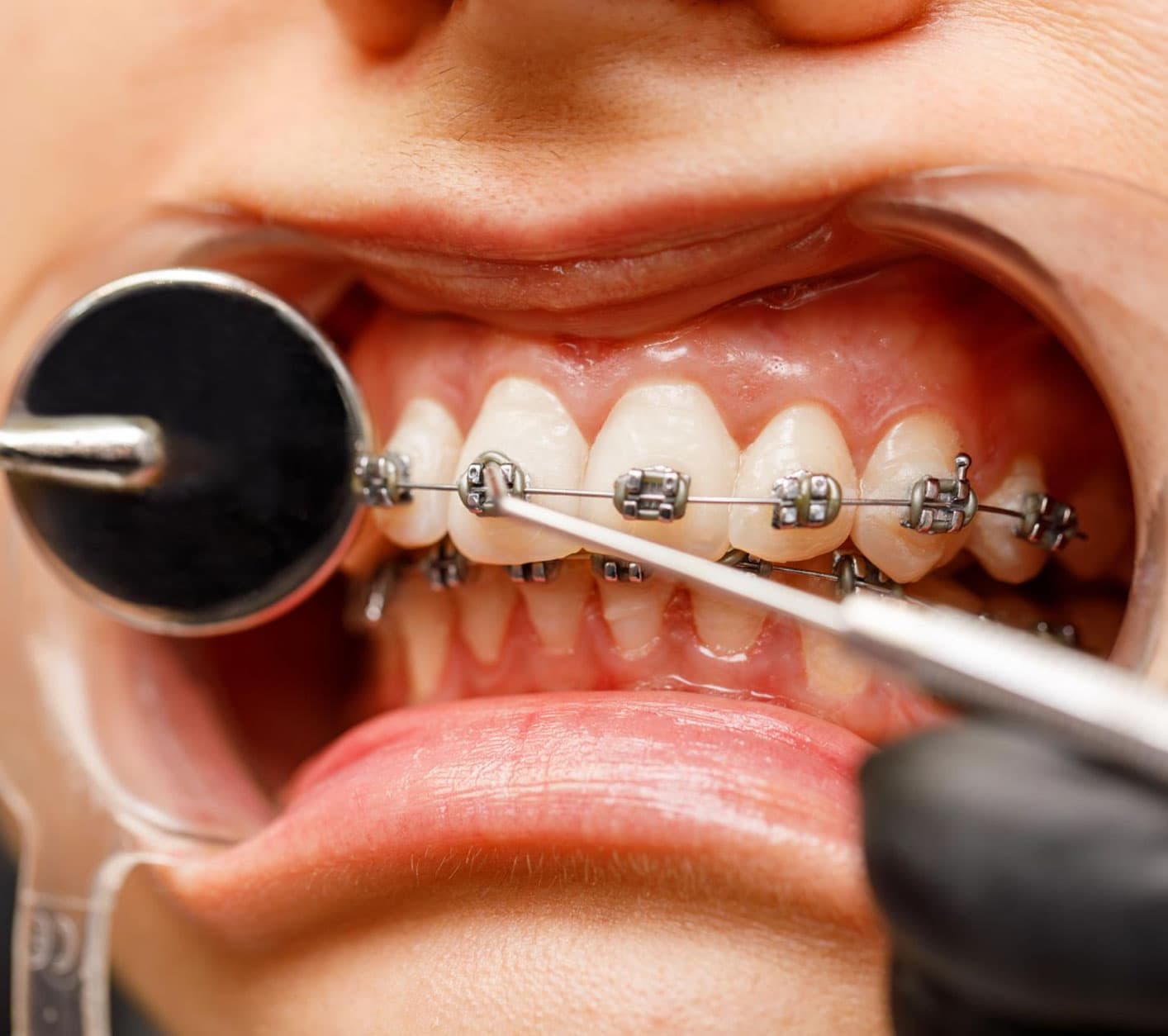 why-choose-eledent-dental-for-dental-clip-treatment-in-banjara-hills