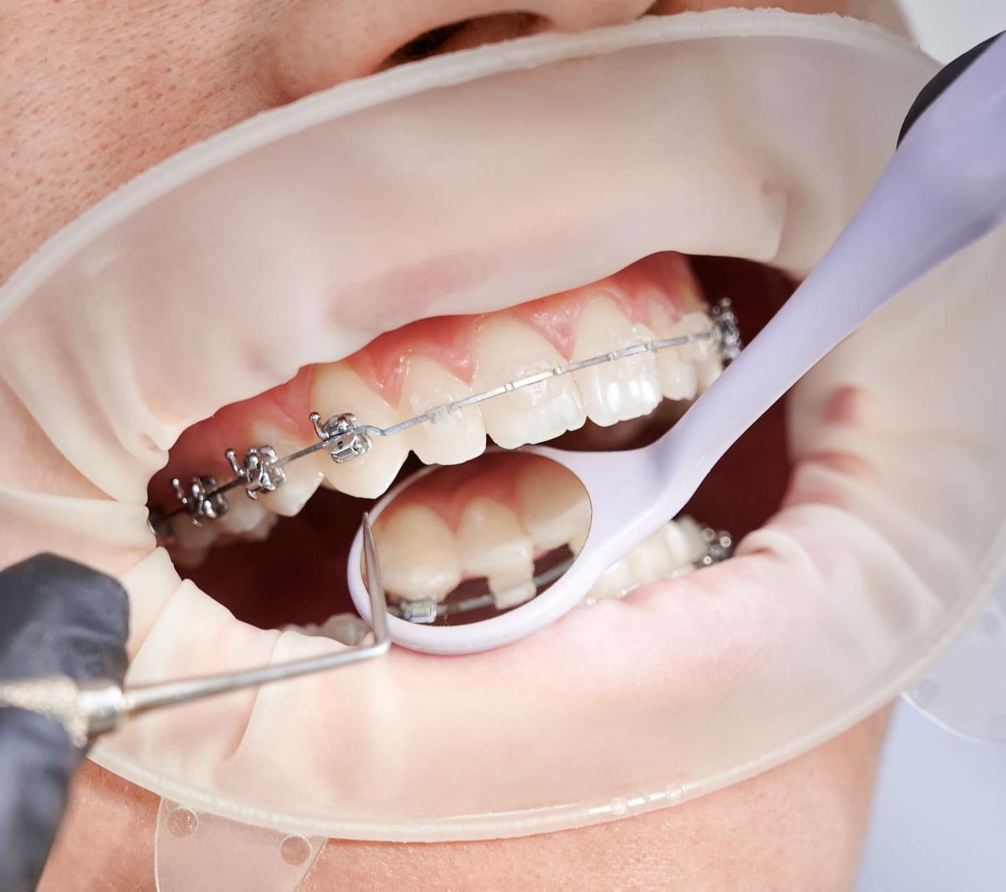 your-dental-clip-treatment-Process-at-eledent-banjara-hills