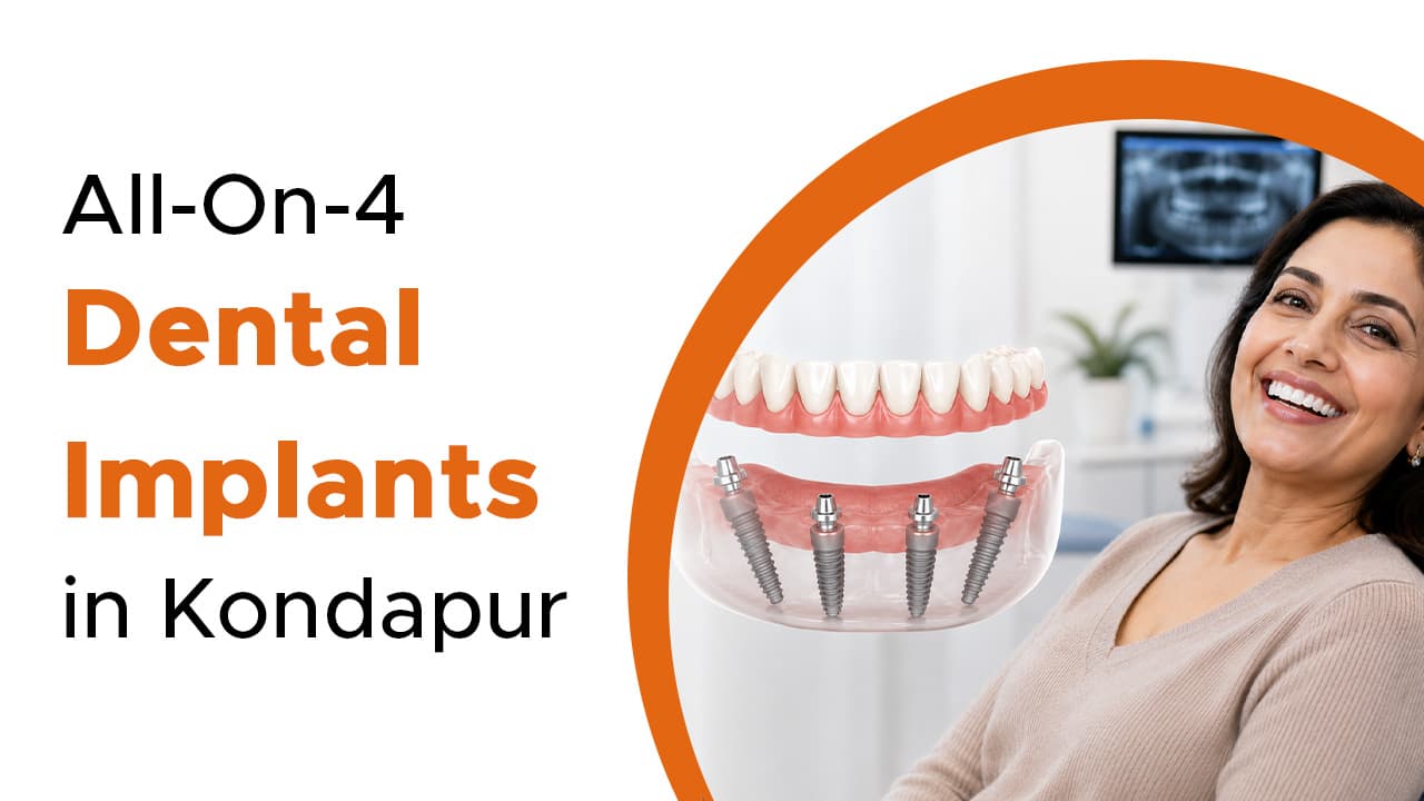 All-On-4 Dental Implants in Kondapur