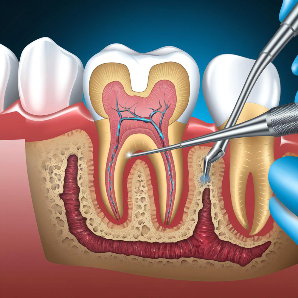 Root Canal Treatment