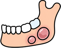 Cysts Forming Around the Jawbone