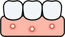 Pimple-Like Sores on Gums