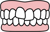 Sudden Overcrowding of Front Teeth