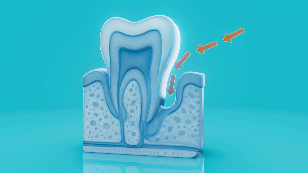 Wisdom Tooth Removal