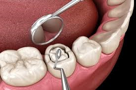 Fillings