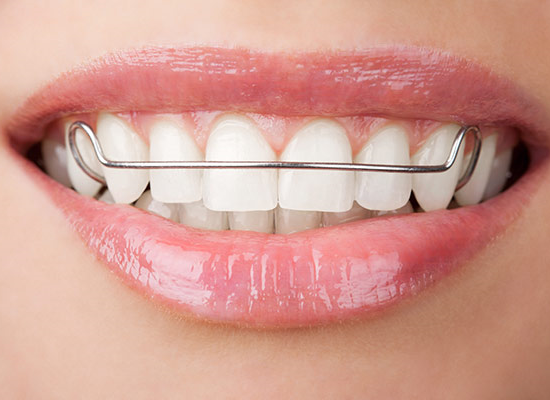 Retainer Aligners