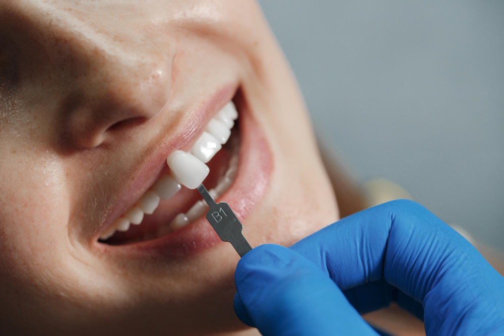 Root Canal Treatment at Eledent Kondapur