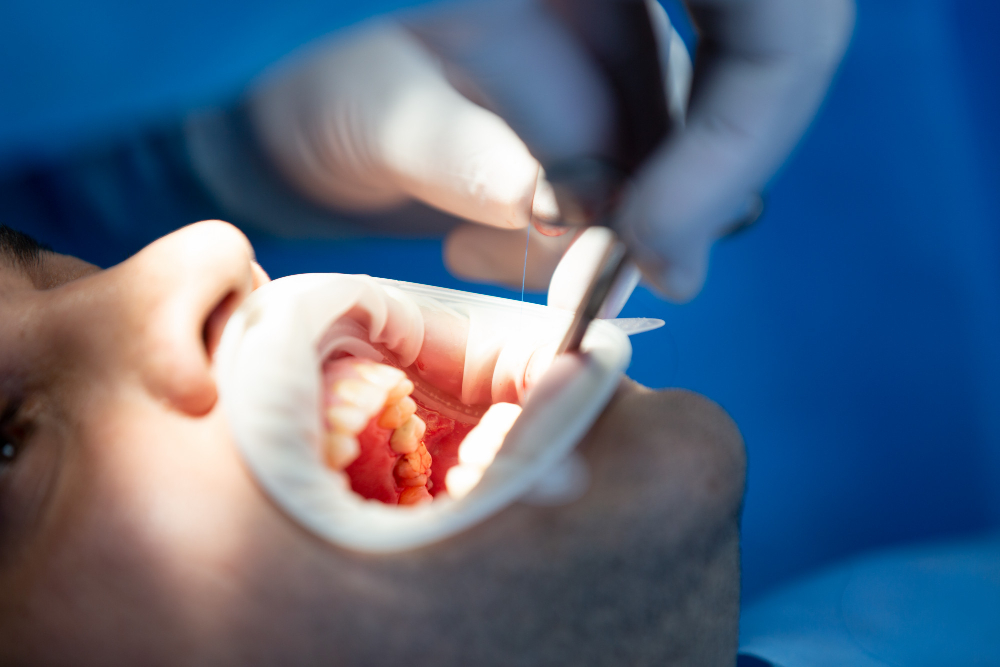Root Canal Treatment at Eledent Kondapur