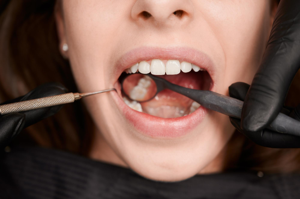 Root Canal Treatment at Eledent Kondapur