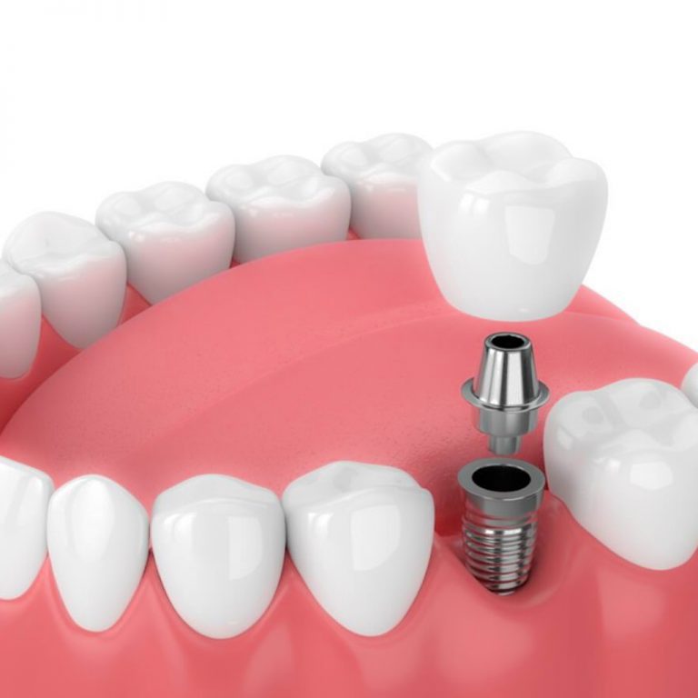 Dental Implants in Hyderabad Dental Implant Surgery Eledent Dental