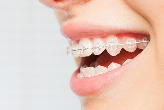 before and after Dental Implant treatment