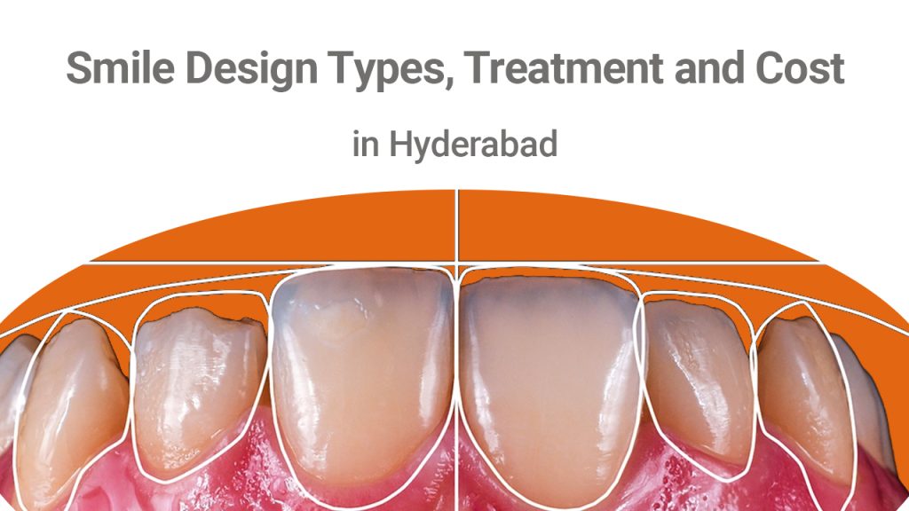 What is Smile Design? Types, Treatment & Its Cost