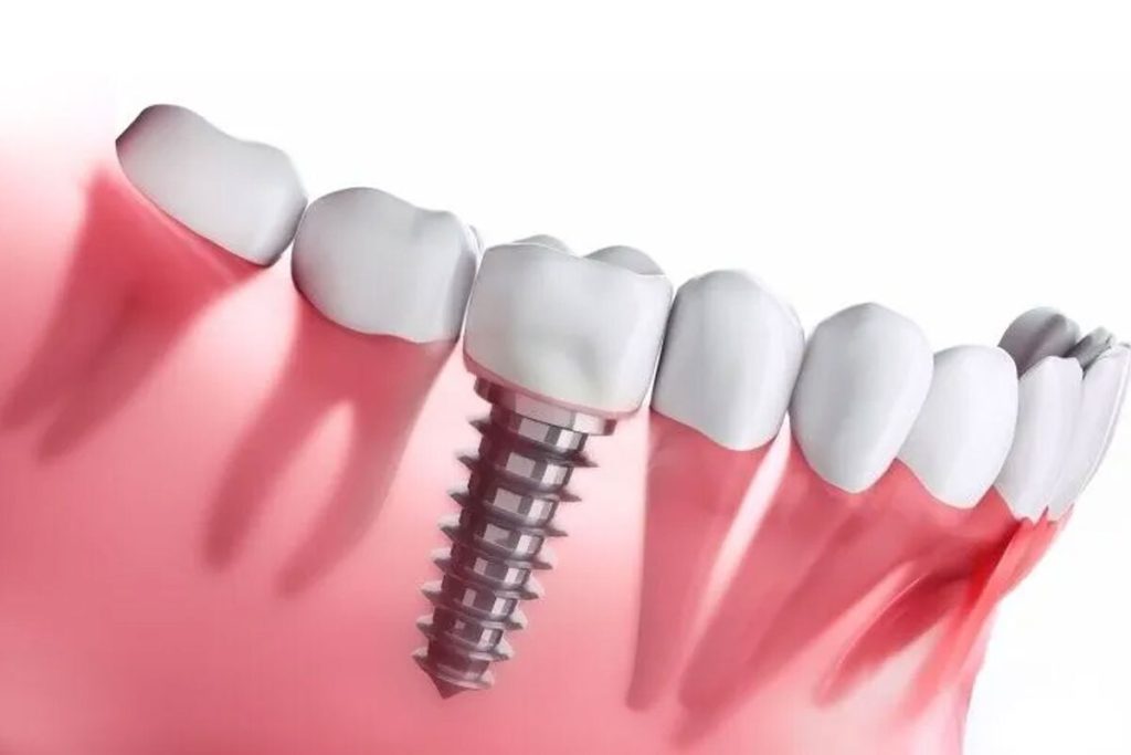 Types of Dental Implants and Which One is Best for You?