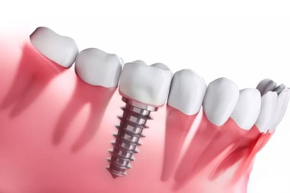 types of dental implants