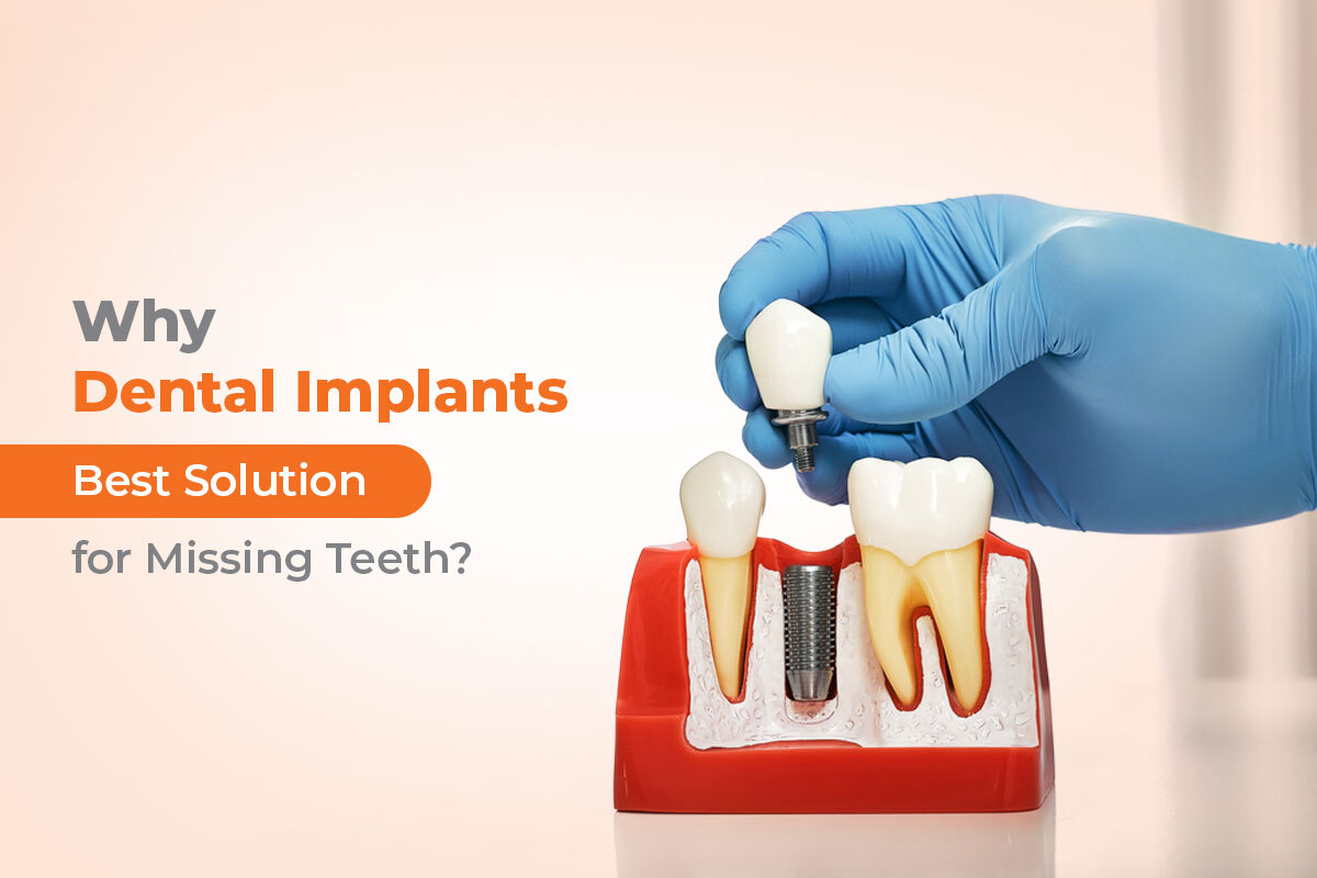 why dental implants are the best solution for missing teeth