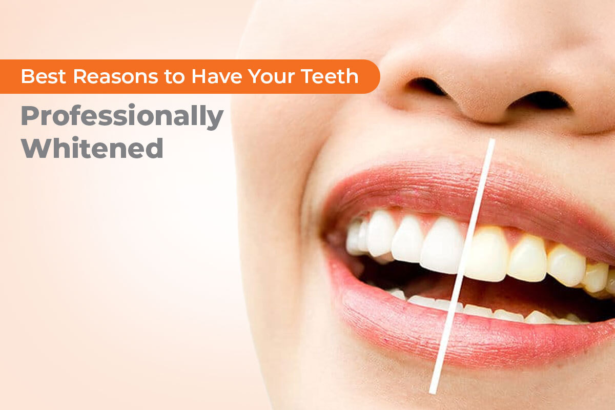 Best-Reasons-to-Have-Your-Teeth-Professionally-Whitened-