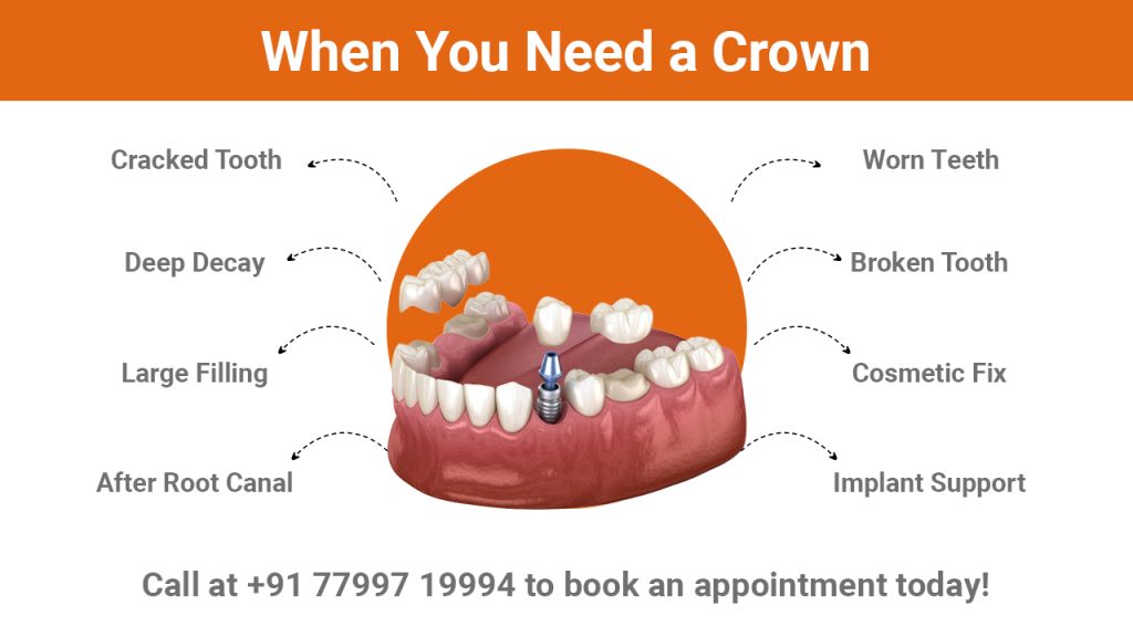 when you need a crown