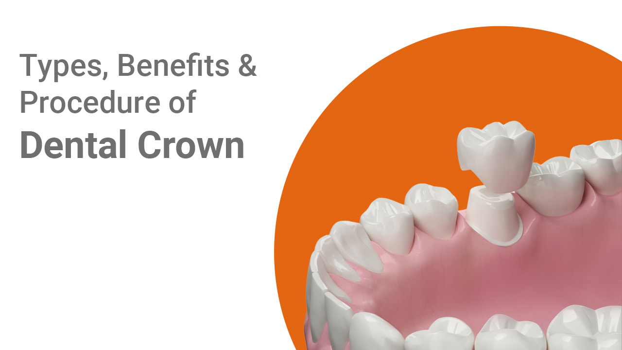 types , benefits & procedure of dental crown