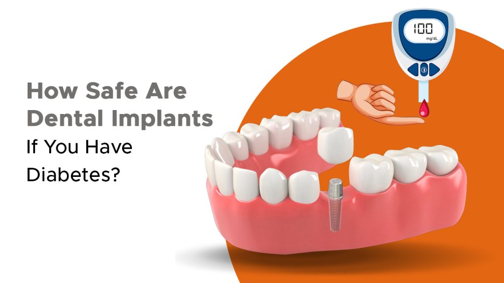 How Safe Are Dental Implants If You Have Diabetes?