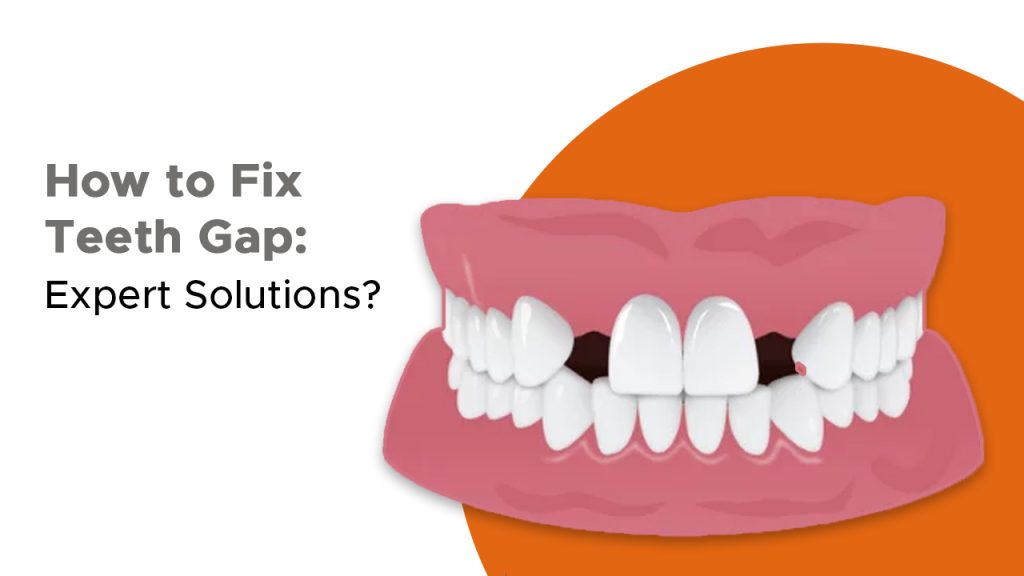 How to Fix Teeth Gap: Expert Solutions?