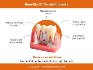 benefits of dental implants