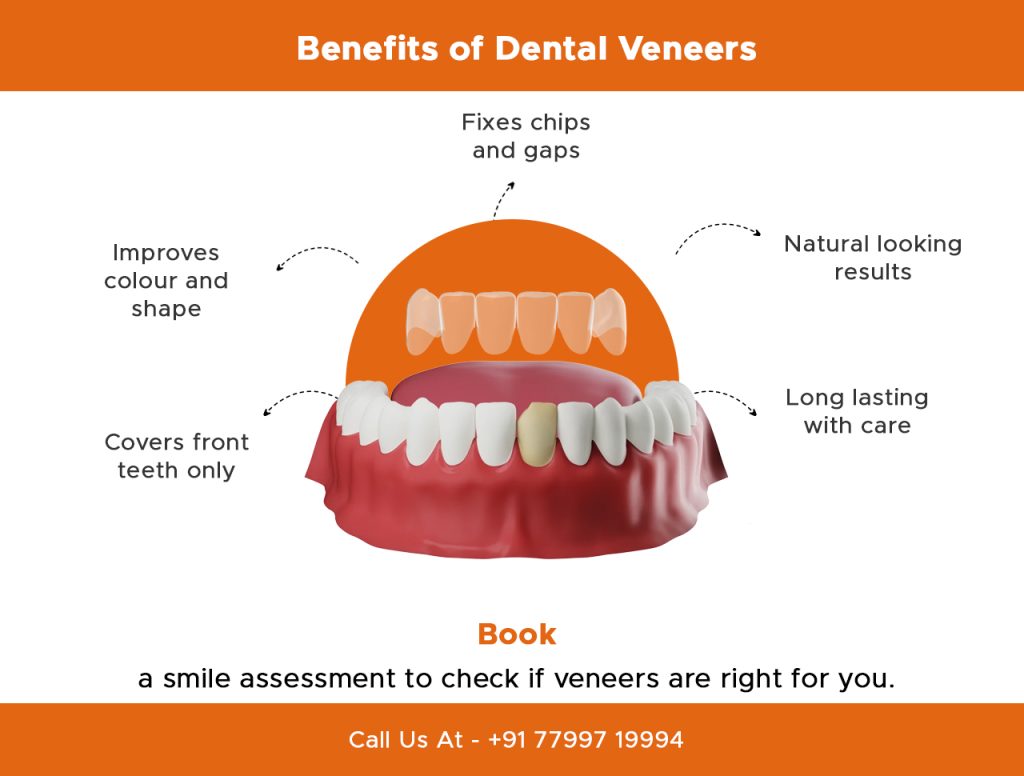 dental veneers work