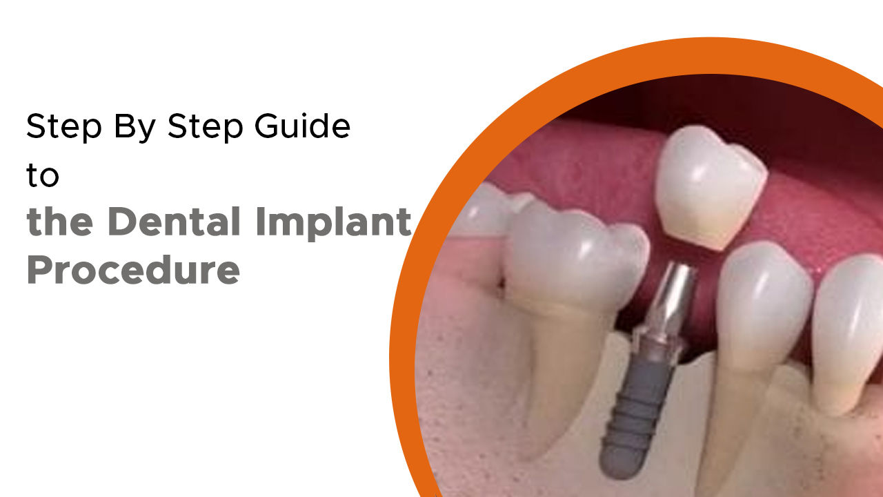 guide to the dental implant procedure